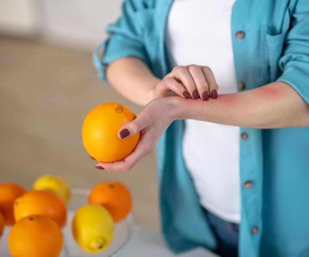 Cytrusy mogą być niebezpieczne. Jak rozpoznać objawy alergii?