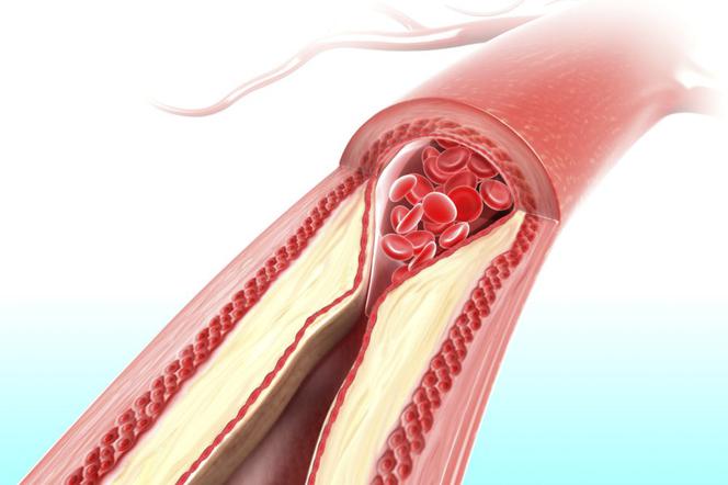 24 września - Dzień Świadomości Hipercholesterolemii Rodzinnej 