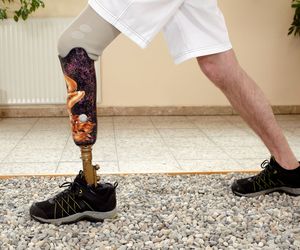 Hemimelia to wada wrodzona kończyn. Przyczyny, objawy i leczenie hemimelii