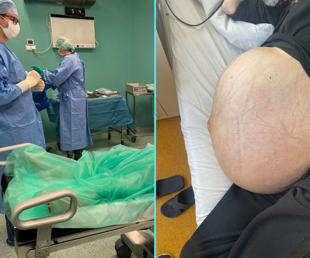 38-latka ze Świdnicy wyhodowała 20 kg guza. Ten rak długo nie daje objawów