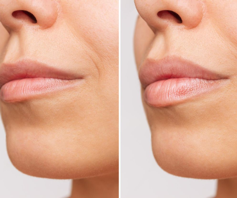 Nie wydasz majątku, a twoje usta zyskają objętość. Najlepsze naturalne sposoby