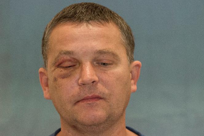 Wydrukowali mu nowe kości twarzy
