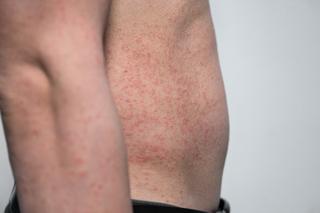 Wzrost zachorowań na groźną chorobę skóry. Lekarze alarmują: wakacje sprzyjają zakażeniu
