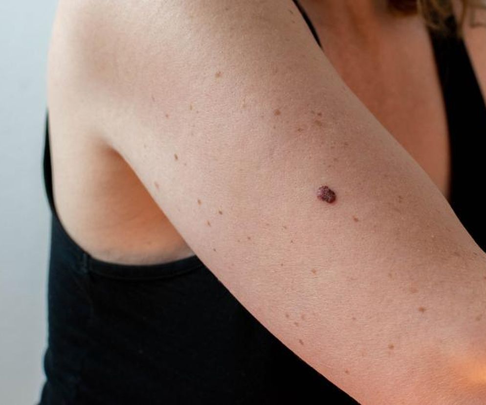 Najczęściej spotykany rak skóry. Mało znany, a znacznie częstszy niż czerniak