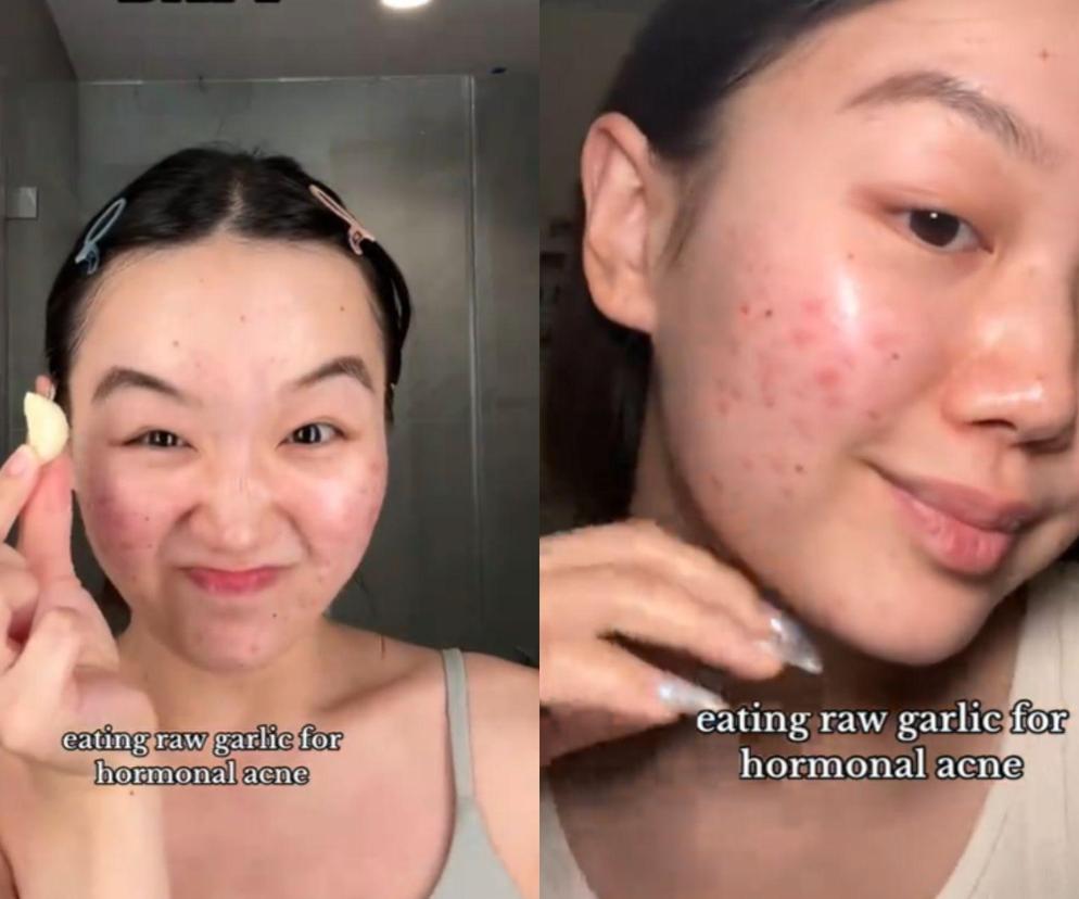 Twierdzi, że wyleczyła trądzik czosnkiem. Wideo obejrzało ponad 25 mln ludzi