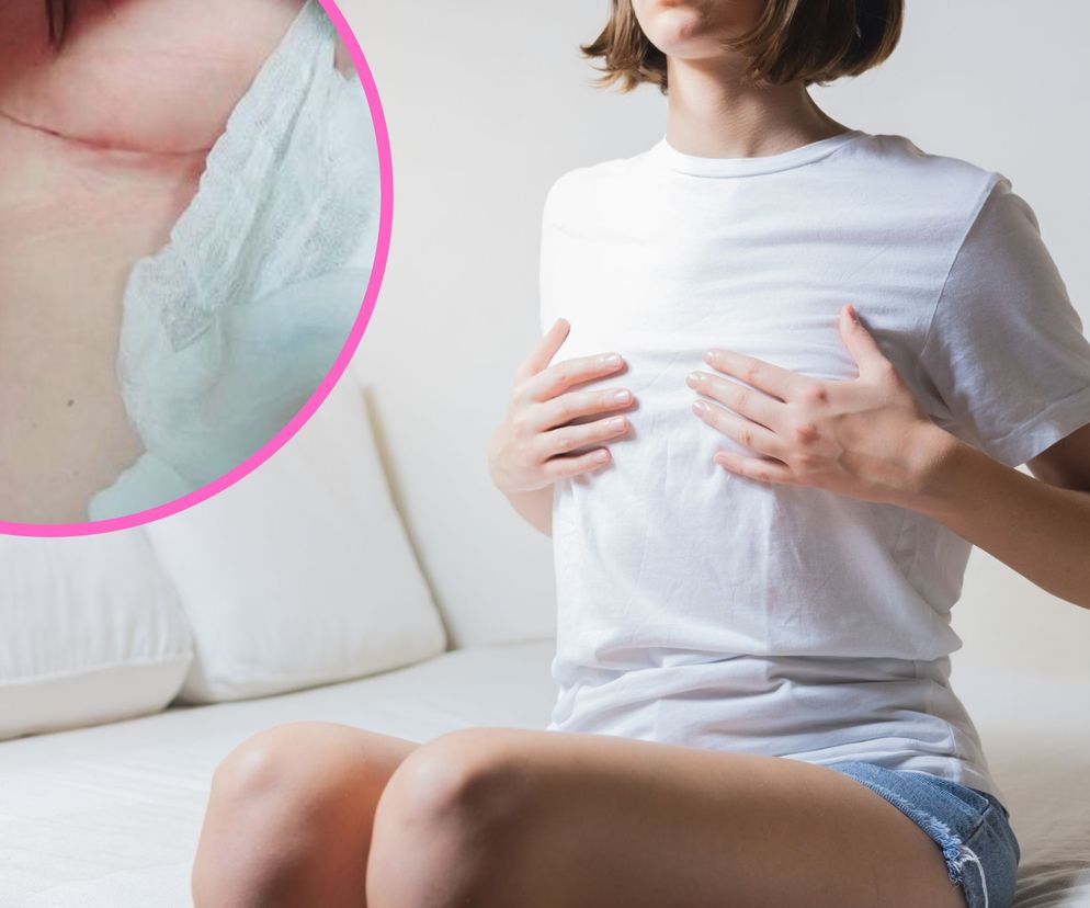 „Zmniejszyłam biust na NFZ”. Komu przysługuje refundacja operacji? 