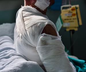 10-latek otarł się o garnek i stanął w płomieniach! Plecy i twarz poparzone!