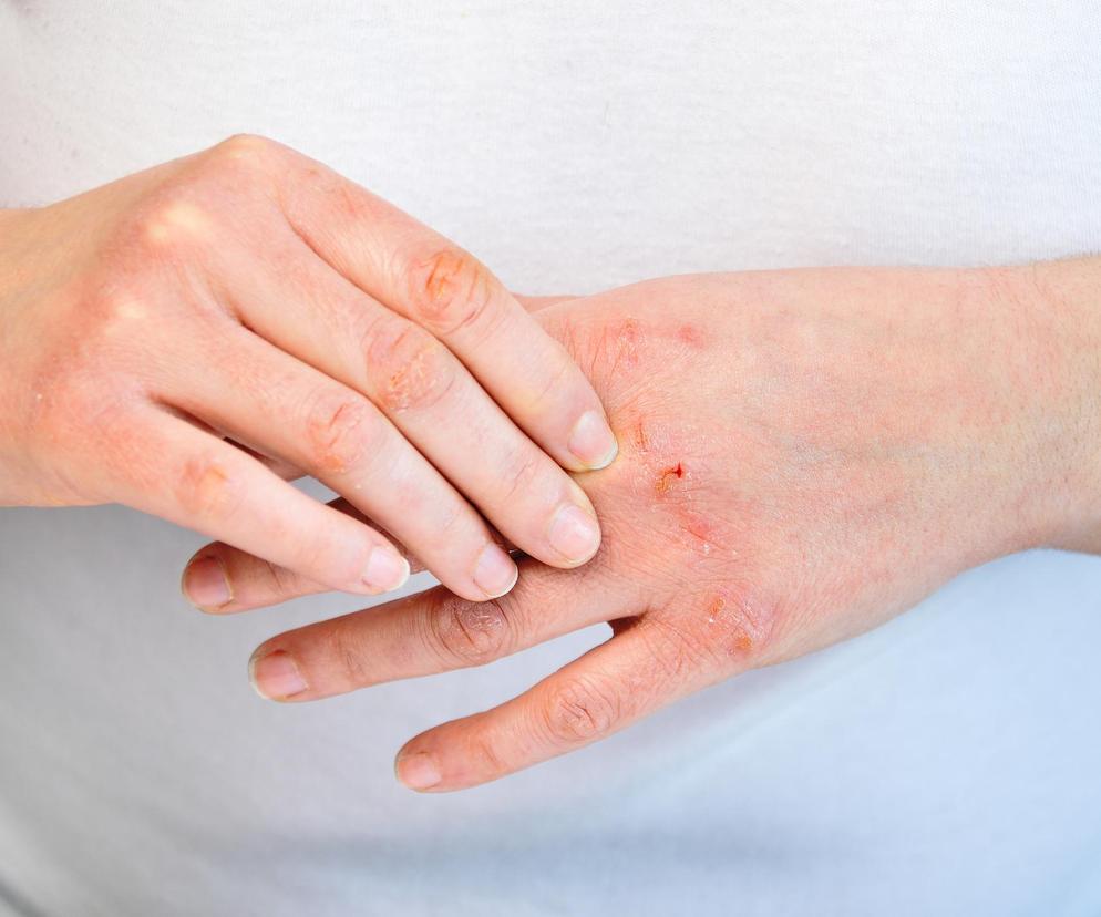 Domowy kosmetyk na spierzchnięte dłonie. Tanio i szybko zrobisz go z tych dwóch składników