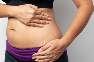 Brzuch po porodzie - zobacz jak naprawdę wygląda brzuch po ciąży