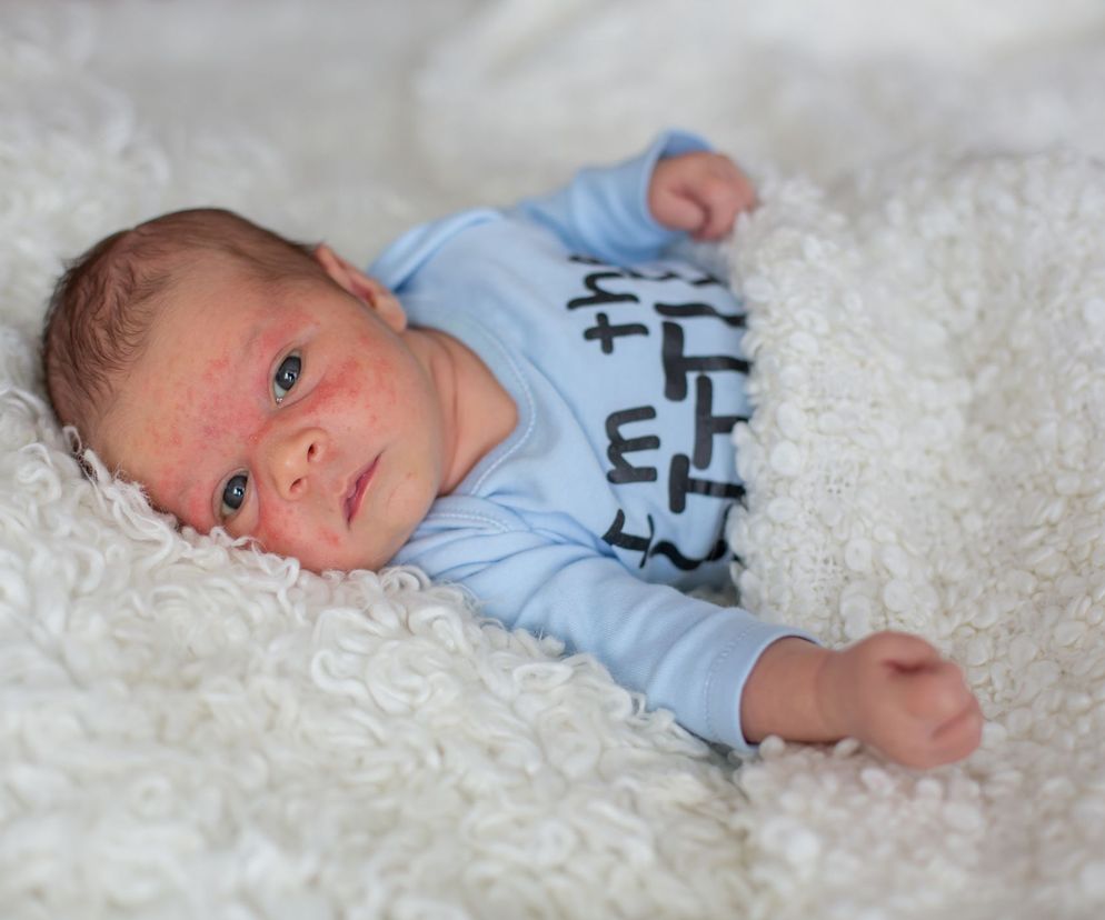 Parwowirus B19 atakuje przede wszystkim dzieci, ale także dorosłych - może być bardzo niebezpieczny, szczególnie dla kobiet ciężarnych.