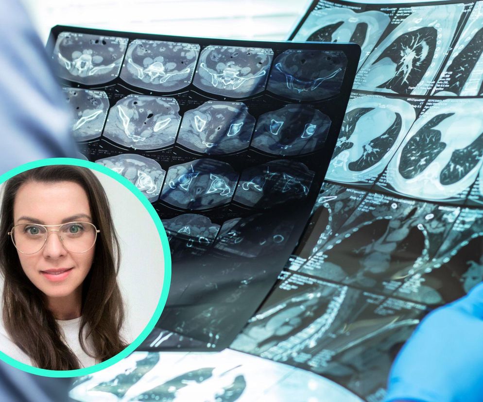 Możesz mieć udar i o tym nie wiedzieć? Neurolog: To bardzo popularny błąd