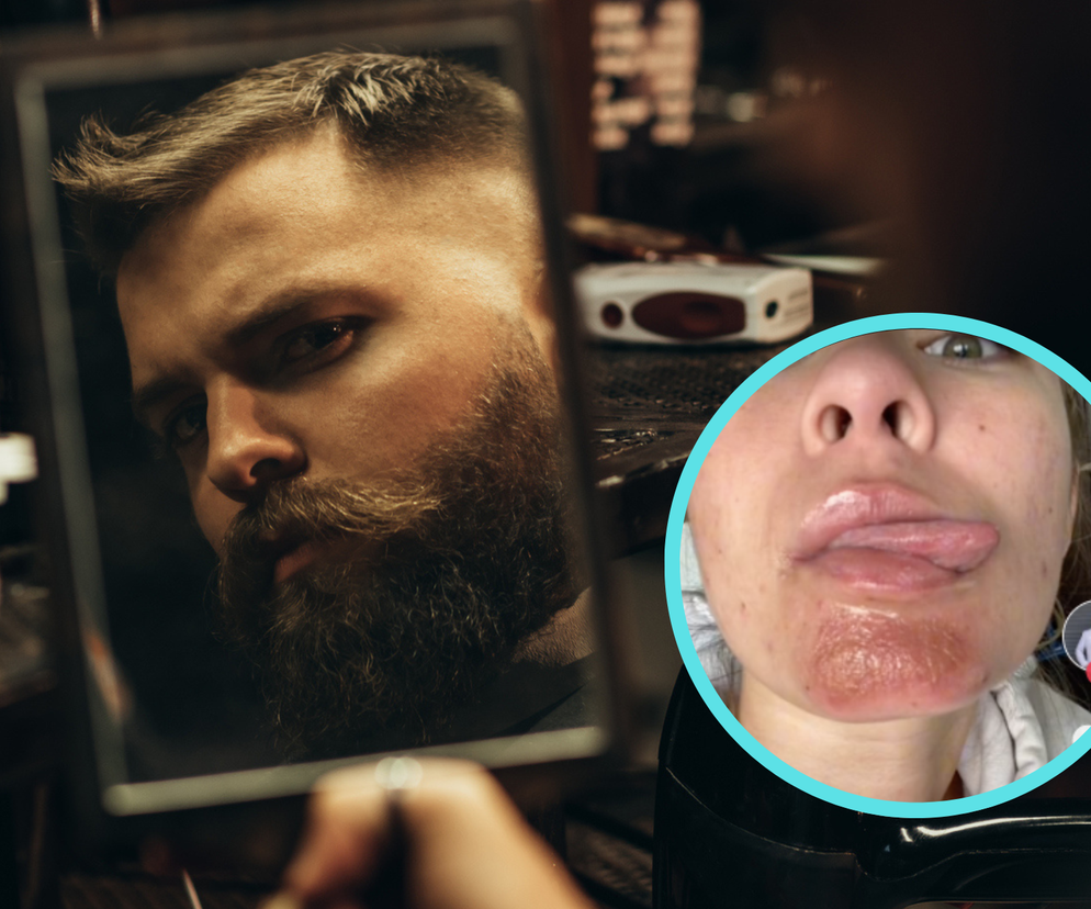 Twój wybranek ma brodę? Całowanie może skończyć się paskudną infekcją