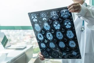 Wykryją Alzheimera zanim pojawią się objawy. Wszystko dzięki tej wskazówce