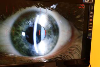 Szpital w Sosnowcu bije rekordy. To absolutny lider w przeszczepach rogówki w Polsce