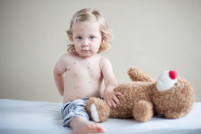 Wysypka u dziecka –  przyczyny wysypki, objawy, leczenie