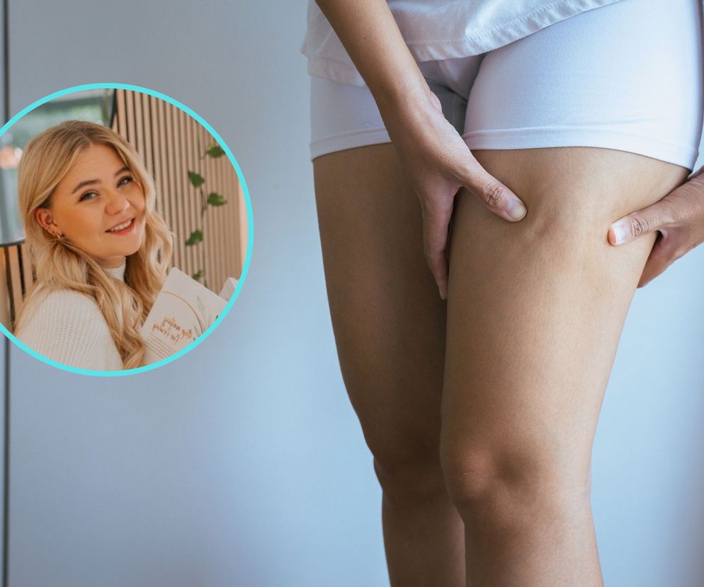 Przez lata nie mogła schudnąć. Przyczyną była choroba grubych nóg