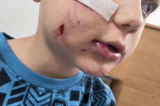 Pies pogryzł 4-letniego Frania. Chłopczyk w szpitalu, policja szuka właściciela