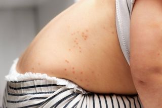 Zapomniana choroba wróciła po pandemii. Pediatra: Ogromne dwie fale zakażeń 