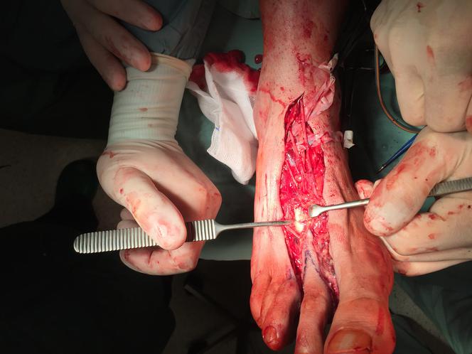 Lekarze przyszyli palec od nogi w miejsce kciuka