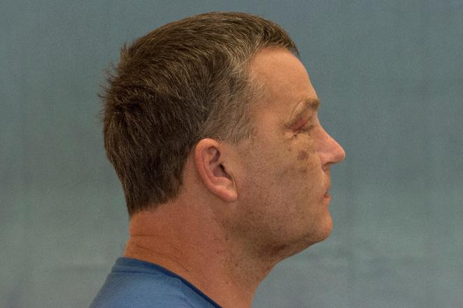 Wydrukowali mu nowe kości twarzy