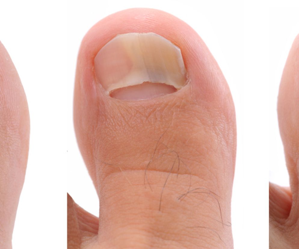 Leczenie grzybicy paznokci