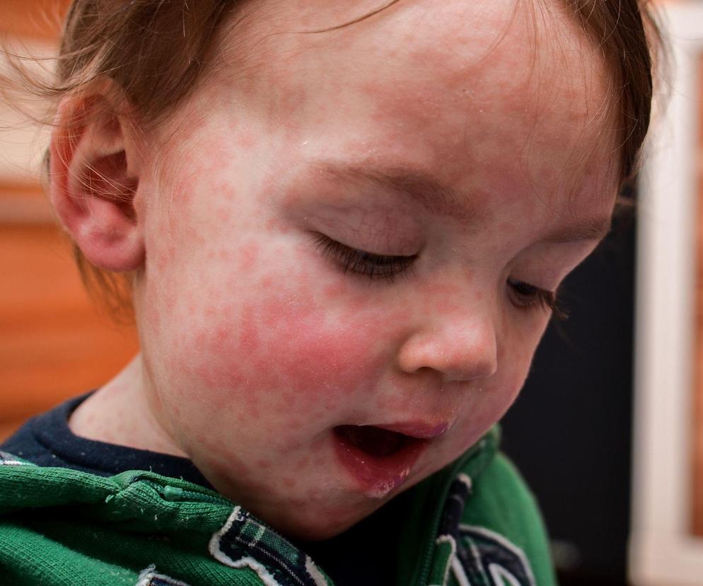 60 razy więcej przypadków odry niż przed rokiem