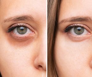 Tania maść z apteki czyni cuda dla skóry pod oczami. Efekty cię zachwycą