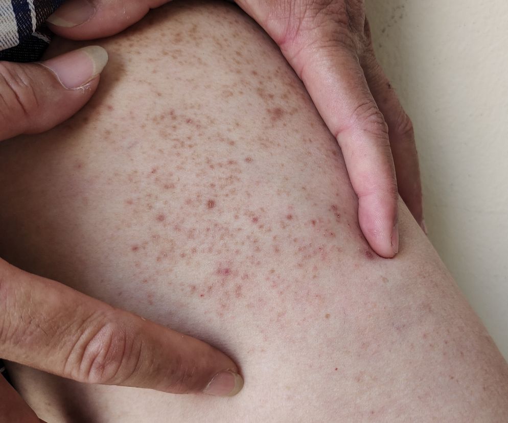 Mało znany objaw cukrzycy. Pojawia się na skórze