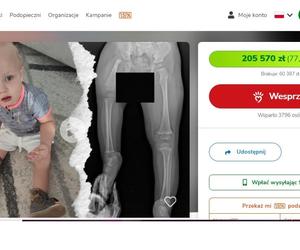 Przed Filipkiem kilka operacji. Chłopiec urodził się  z wadą ortopedyczną