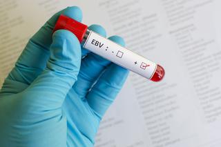 Wirus Epsteina-Barr (EBV) może być przyczyną raka. Co to jest wirus EBV?