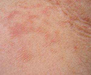 GRUŹLICA TOCZNIOWA SKÓRY może rozwinąć się w RAKA kolczystokomórkowego skóry