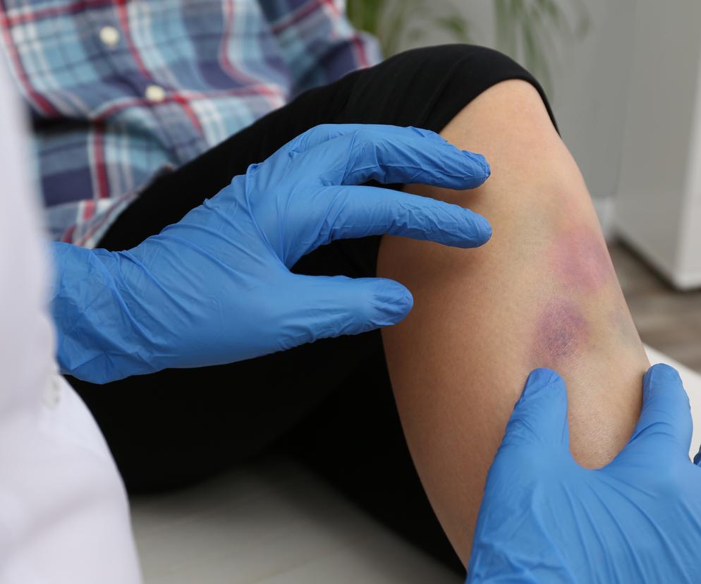 Myślała, że jej synek ma siniaki, bo jest niezdarny. Okazało się, że to objaw groźnej choroby