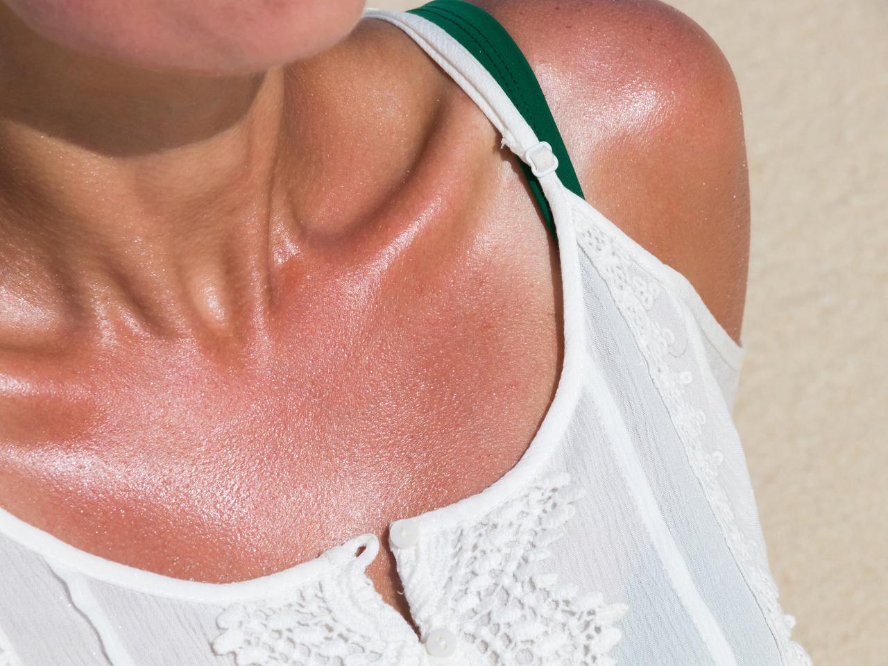 Co piąta osoba zachoruje na raka skóry - ocenia ekspert. Liczba nowych przypadków jest rekordowa