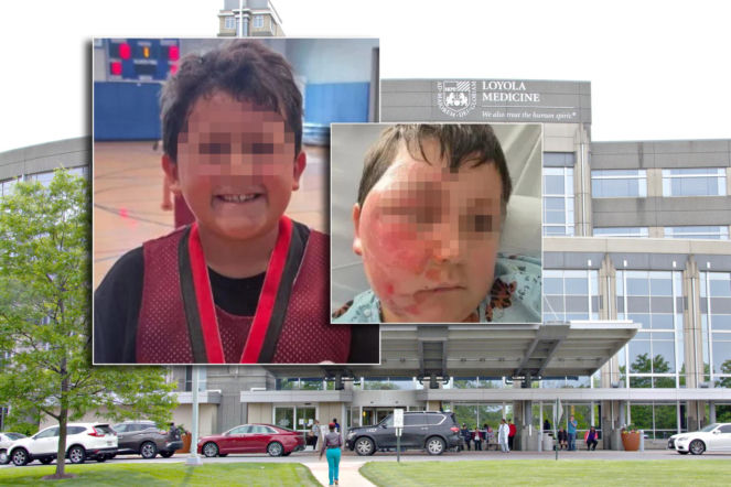 Wsadził do mikrofali gniotka, eksplodował mu na twarz. 9-latek oszpecony na zawsze