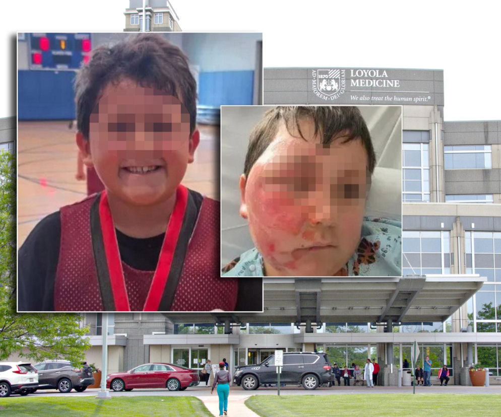 Wsadził do mikrofali plastik, eksplodował mu na twarz. 9-latek oszpecony na zawsze. Nowy niebezpieczny trend