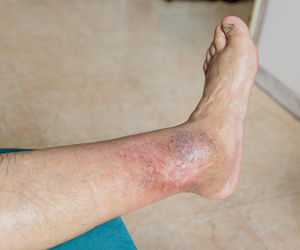 Ekspert: stopa cukrzycowa groźniejsza od wielu nowotworów. „Schodzimy prosto do piekła”