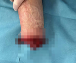 Wojciech Różycki stracił dłoń