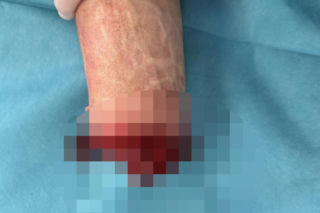 Wojciech Różycki stracił dłoń