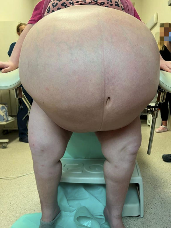 Wycięli pacjentce 100 kg guza
