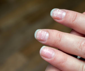 To nie jest brak wapnia! Odkryj, co naprawdę oznaczają białe plamki na twoich paznokciach