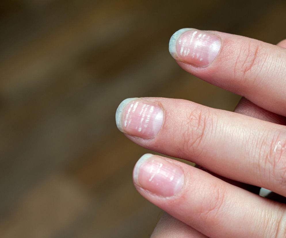 Zbliżenie na dłoń z trzema palcami, których paznokcie pokryte są licznymi, podłużnymi, białymi plamkami, tzw. leukonychią. Dowiedz się, co naprawdę oznaczają białe plamki na paznokciach i czy zawsze świadczą o braku wapnia, na Poradnik Zdrowie.