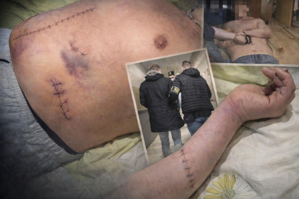 Stanął w obronie kobiety, skatowali go maczetami. Piotrek ledwo przeżył. "Niemal mnie zabili"