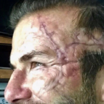 Beckham ma blizny jak Popek! Co się stało z twarzą piłkarza?
