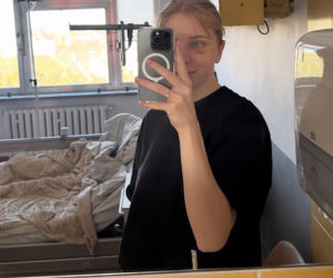 Kamila Sellier po rekonstrukcji oczodołu