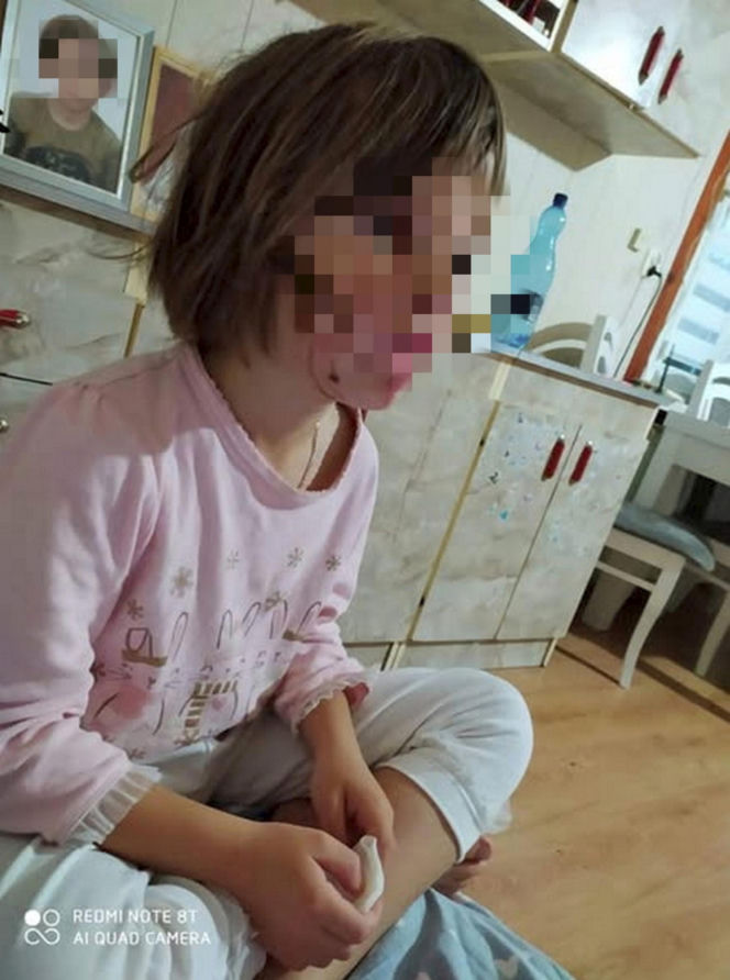 Wyrodna matka zgotowała Julce piekło. Latami wypalała jej kwasem rany na skórze!