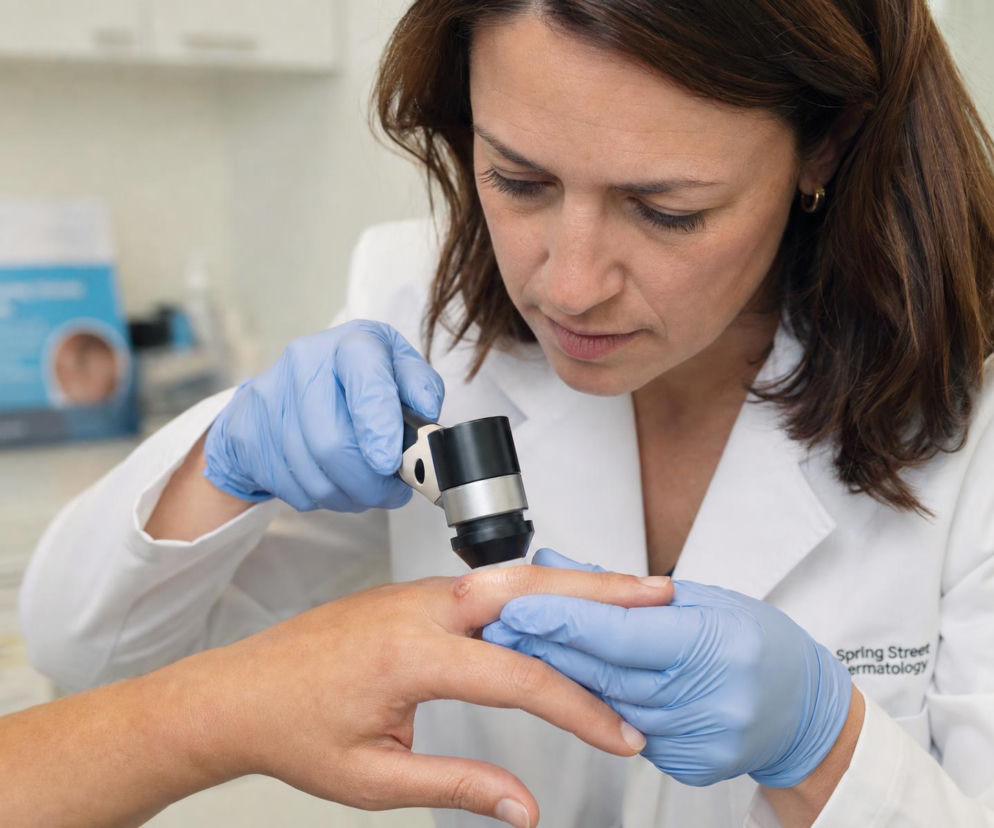 Lekarka w rękawiczkach bada dermatoskopem kurzajkę na palcu pacjenta. O metodach leczenia przeczytasz na Poradnik Zdrowie.