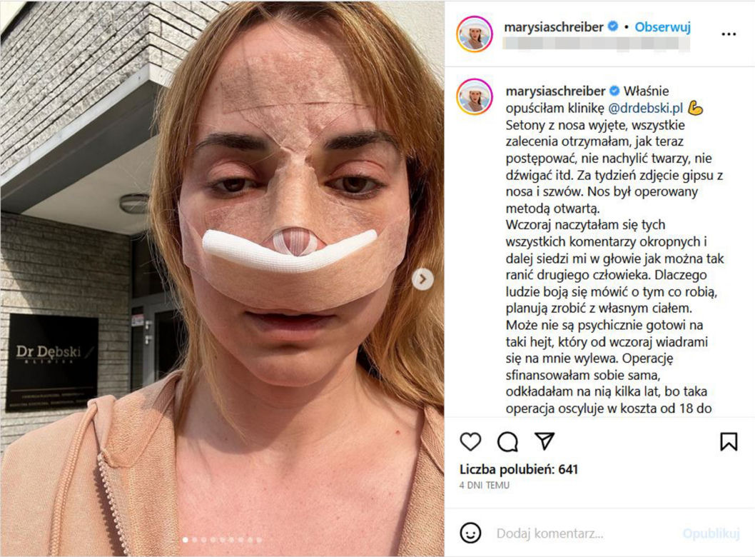 Tak wygląda Marianna Schreiber po operacji nosa