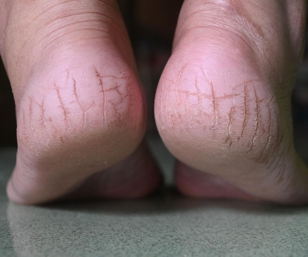 Zbliżenie na suche, popękane pięty, wyraźnie pokazujące głębokie rozcięcia na skórze. Obraz ilustruje powszechny problem dermatologiczny, który może sygnalizować poważniejsze schorzenia, o czym dowiesz się więcej na Poradnik Zdrowie. Wymaga stosowania kremów z mocznikiem.