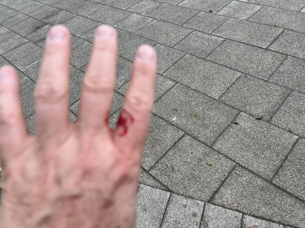 Kobieta pobita przez staruszka, bo zwróciła mu uwagę. "Przewrócił mnie na chodnik i okładał parasolką, potem uderzył pięścią w twarz"