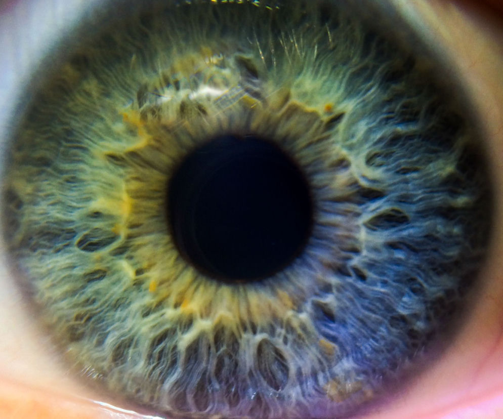 heterochomia